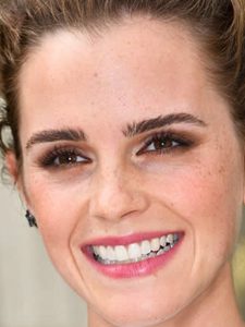 emma watson after veneers