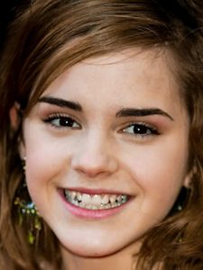 emma watson before veneers