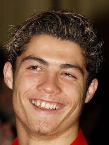 ronaldo before veneers