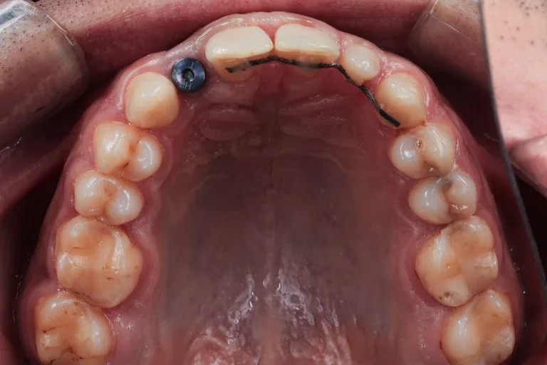 stepanchuk dmytro below implant 1