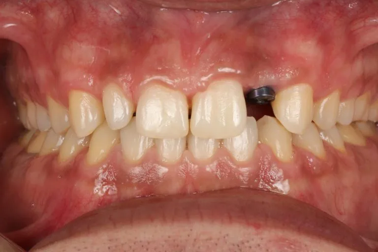 stepanchuk dmytro front isolated implant 1