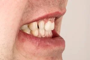 stepanchuk dmytro left preparated tooth 1
