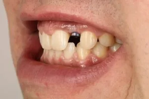 stepanchuk dmytro right implant 1