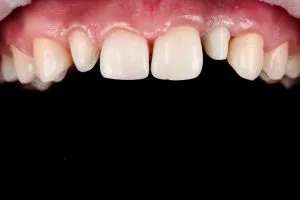 stepanchuk dmytro upper jaw abutment 1