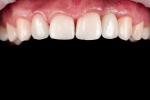 stepanchuk dmytro upper jaw after 1