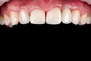 stepanchuk dmytro upper jaw after 1