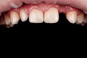 stepanchuk dmytro upper jaw before 1