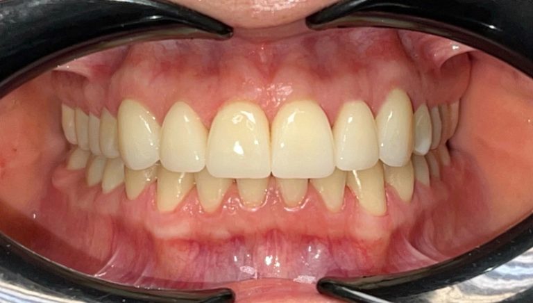 veneer after