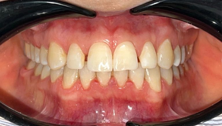 veneer before