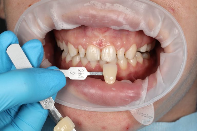 veneer fitting