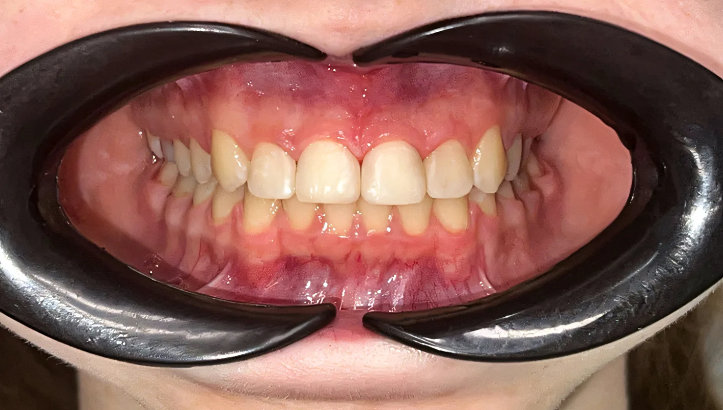 veneers after 6