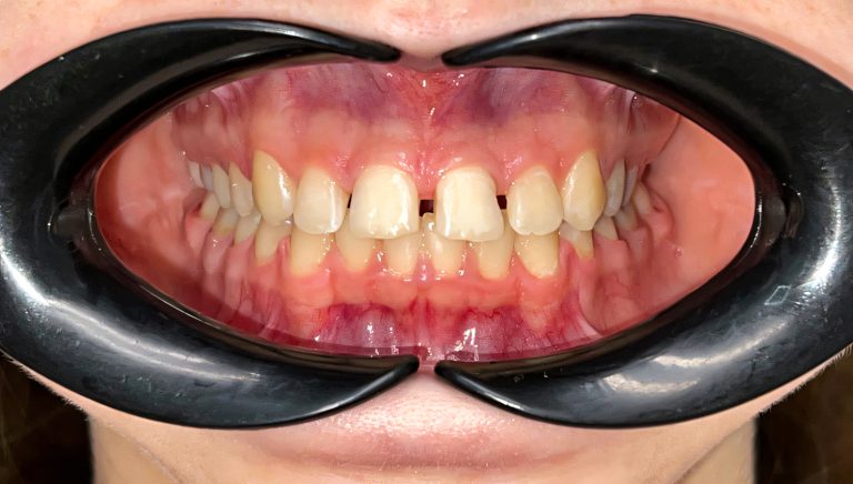 veneers before 6
