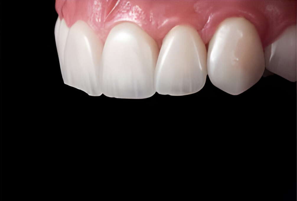 zirconium veneers 2