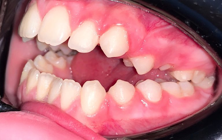 До виправлення відкритого прикусу