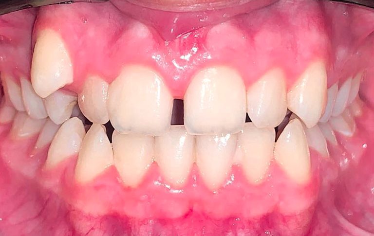 До закриття діастеми (щілини між передніми зубами) та вирівнювання дистопованого зуба