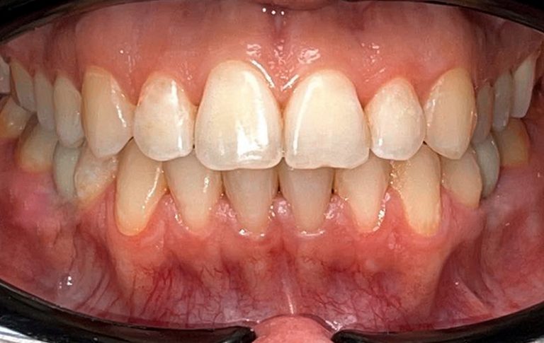 Після виправлення прямого прикусу