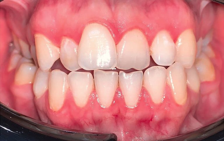 До виправлення прямого прикусу