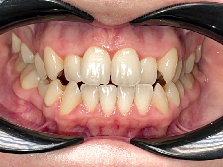 До вирівнювання прикусу