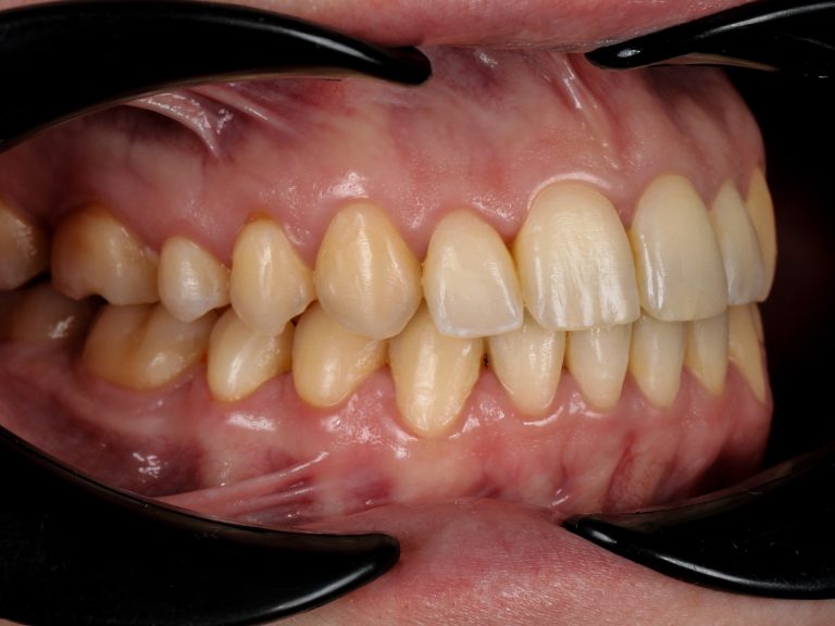 Після вирівнювання зубів брекетами