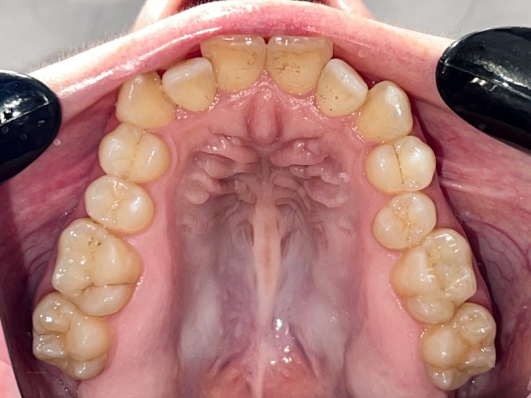 До вирівнювання скупчення зубів (верхня щелепа)