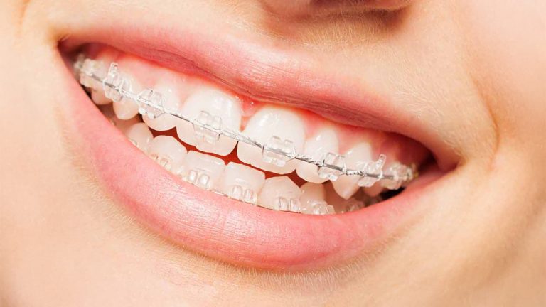 Керамічні брекети