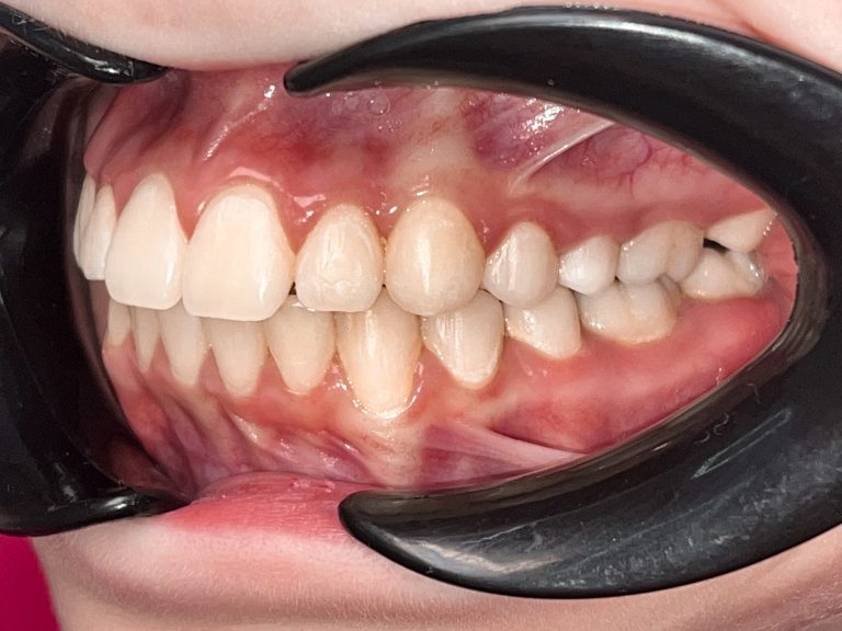 Після вирівнювання зубів