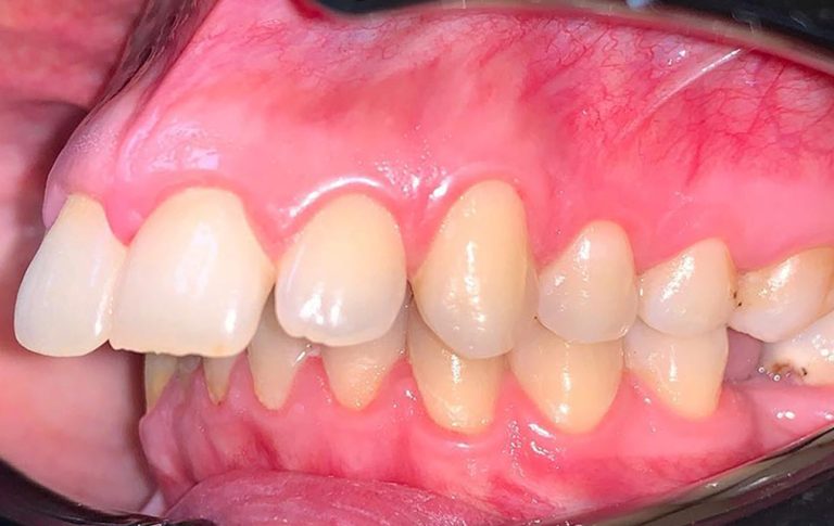 До виправлення дистального прикусу брекетами