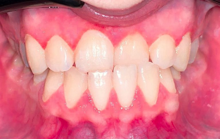 Вирівнювання перехресного прикусу брекетами