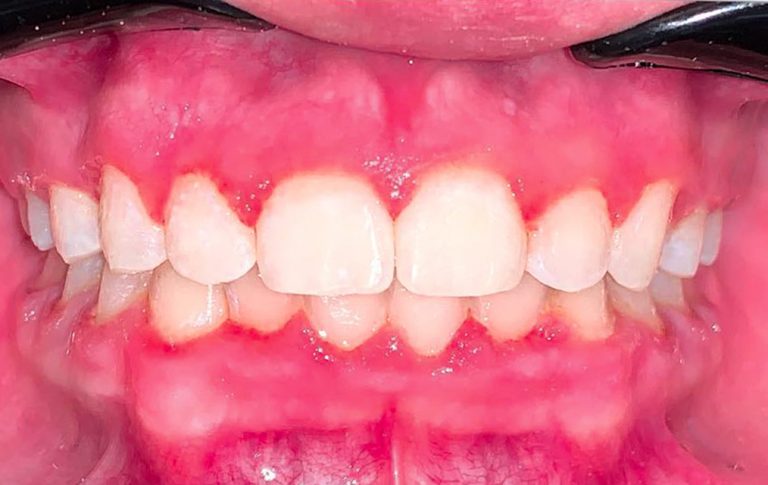 Результат вирівнювання глибокого прикусу